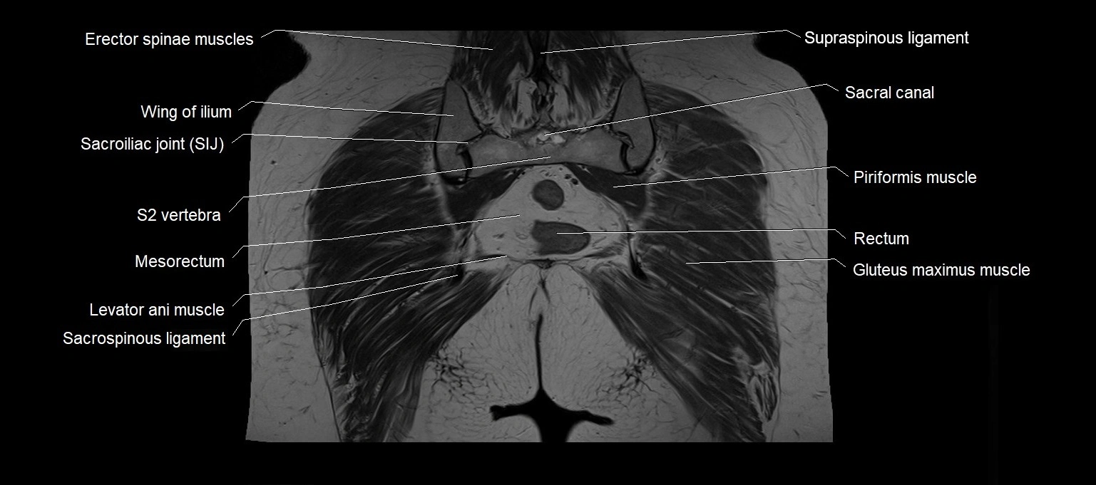 MRI 3T pelvis coronal cross section anatomy image 23.webp